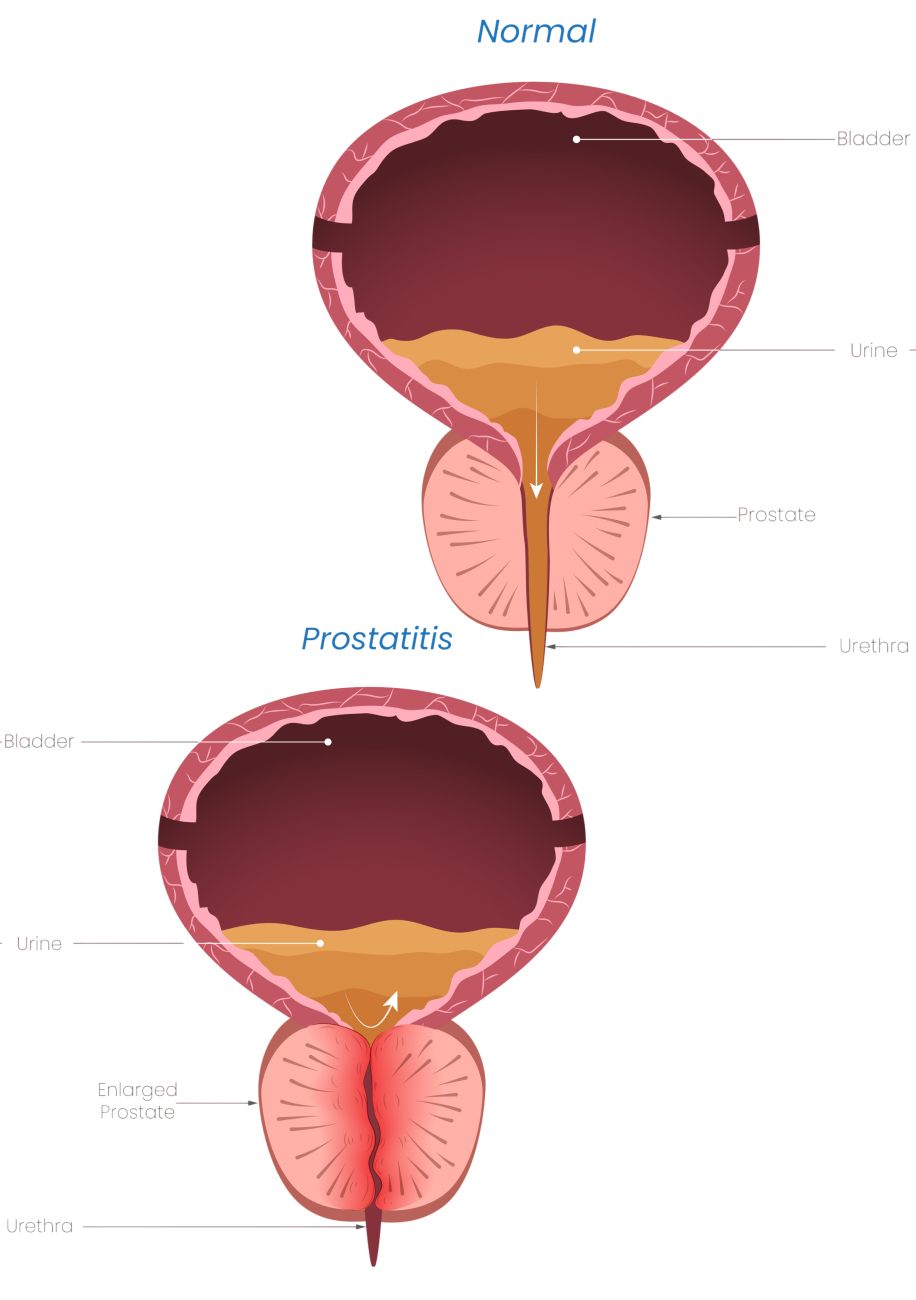Prostate