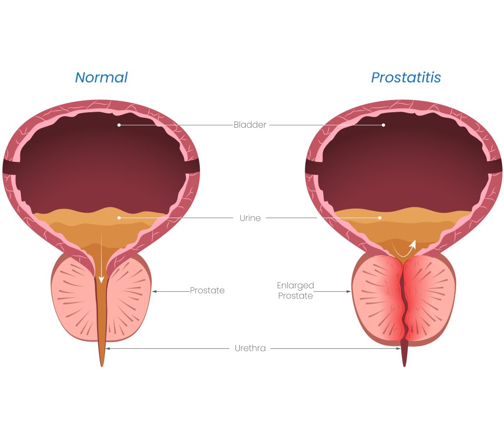 Prostate